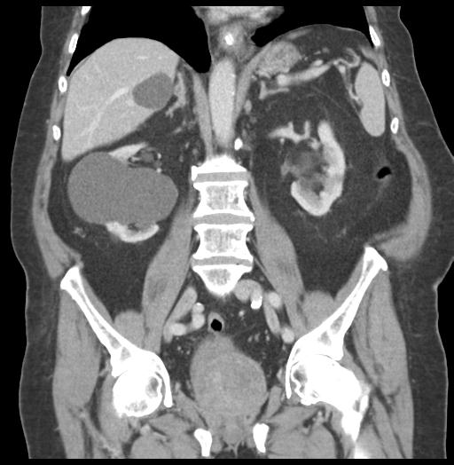 Adult ileal intussusception with secondary obstruction (Radiopaedia 30395-31051 Coronal C+ portal venous phase 37).jpg