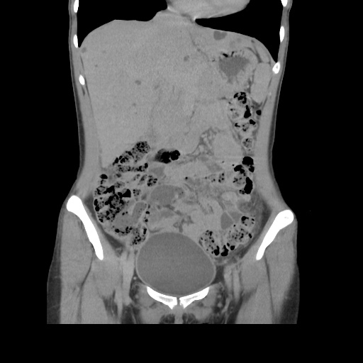 File:Adult polycystic kidney disease (Radiopaedia 48845-53876 Coronal renal excretory phase 15).jpg