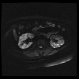 Adult polycystic kidney disease (Radiopaedia 59075-66365 Axial DWI 14).jpg