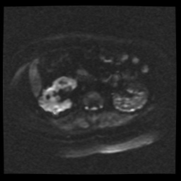 Adult polycystic kidney disease (Radiopaedia 59075-66365 Axial DWI 46).jpg