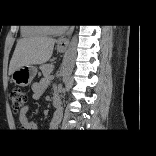 Adult polycystic kidney disease (Radiopaedia 59075-66368 Sagittal non-contrast 48).jpg