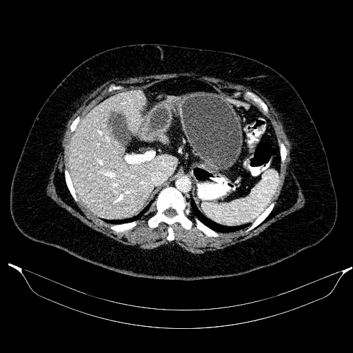 File:Afferent loop syndrome - secondary to incarcerated trocar site hernia (Radiopaedia 82959-97305 Axial C+ portal venous phase 58).jpg