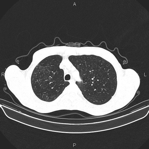 Air bronchogram in pneumonia (Radiopaedia 85719-101512 Axial lung window 17).jpg