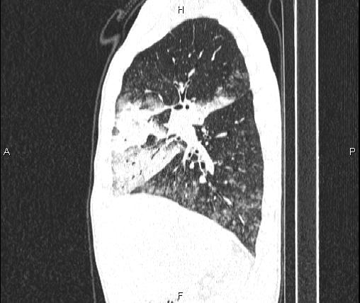 Air bronchogram in pneumonia (Radiopaedia 85719-101512 Sagittal lung window 33).jpg
