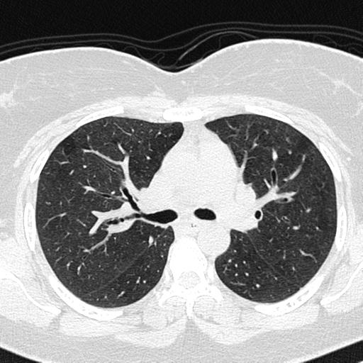 File:Air trapping in small airway disease (Radiopaedia 61685-69694 Axial lung window 68).jpg
