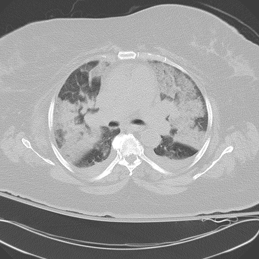All trans retinoic acid (ATRA) syndrome (Radiopaedia 38212-40229 Axial lung window 24).jpg