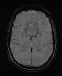 File:Alzheimer's disease- with Gerstmann syndrome and dressing apraxia (Radiopaedia 54882-61150 Axial SWI 20).png