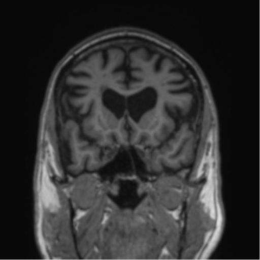 Alzheimer's disease- with Gerstmann syndrome and dressing apraxia (Radiopaedia 54882-61150 Coronal T1 60).png