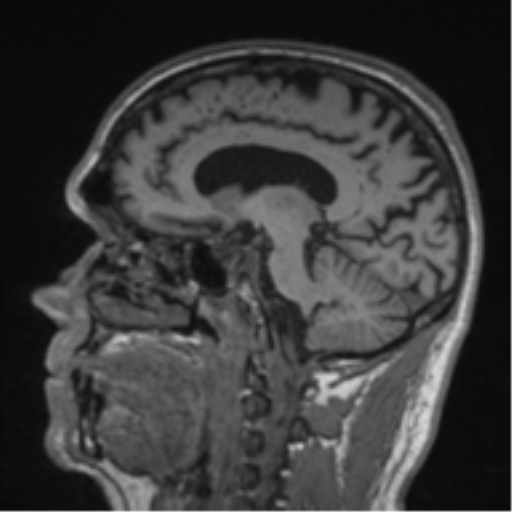 Alzheimer's disease- with Gerstmann syndrome and dressing apraxia (Radiopaedia 54882-61150 Sagittal T1 41).png