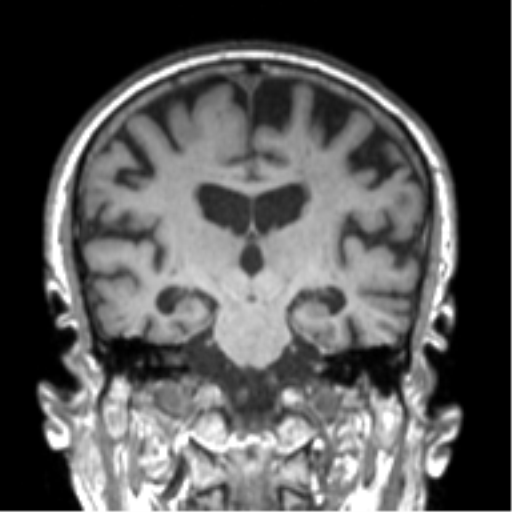 File:Alzheimer disease and cerebral amyloid angiopathy (Radiopaedia 64234-73011 Coronal T1 29).png
