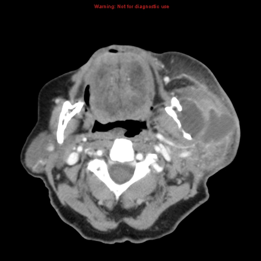 Ameloblastoma (Radiopaedia 27437-27631 A 37).jpg