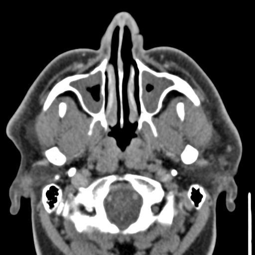 File:Ameloblastoma (Radiopaedia 33677-34806 Axial non-contrast 8).png