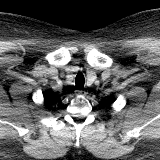 Ameloblastoma (Radiopaedia 38520-40623 Axial non-contrast 73).png