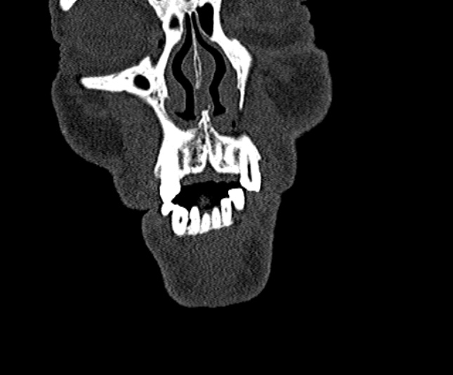 Ameloblastoma (Radiopaedia 51921-57766 Coronal bone window 21).jpg