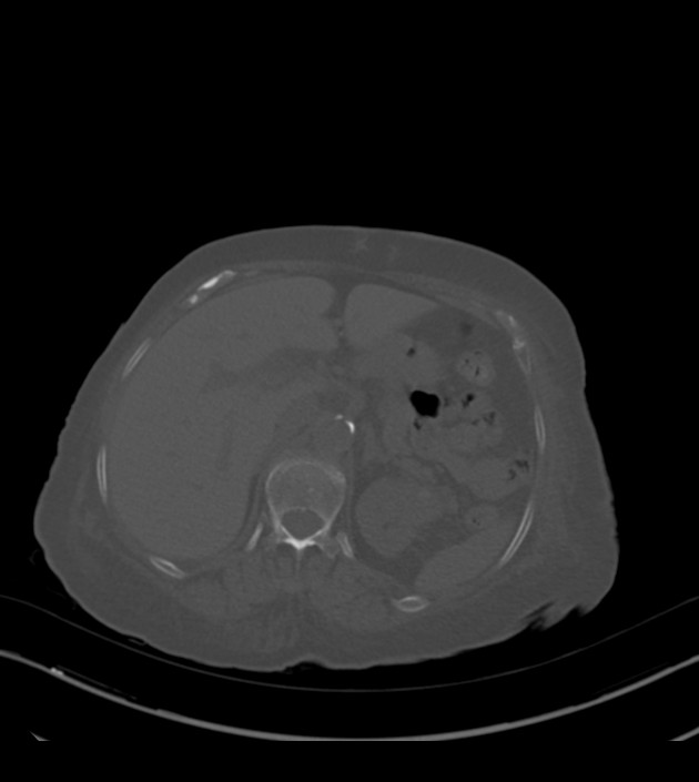 Amiodarone deposition in the liver (Radiopaedia 77587-89780 Axial bone window 85).jpg