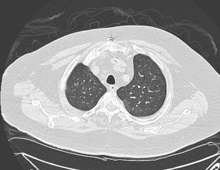 File:Amiodarone lung (Radiopaedia 62514-70769 Axial lung window 18).jpg