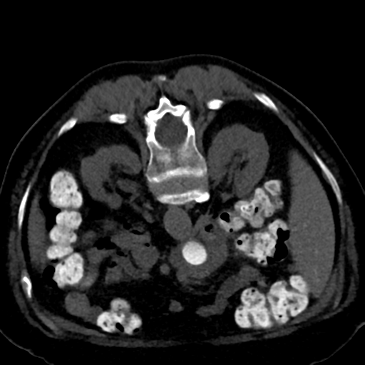 Ampullary adenocarcinoma (Radiopaedia 34013-35241 C 44).png
