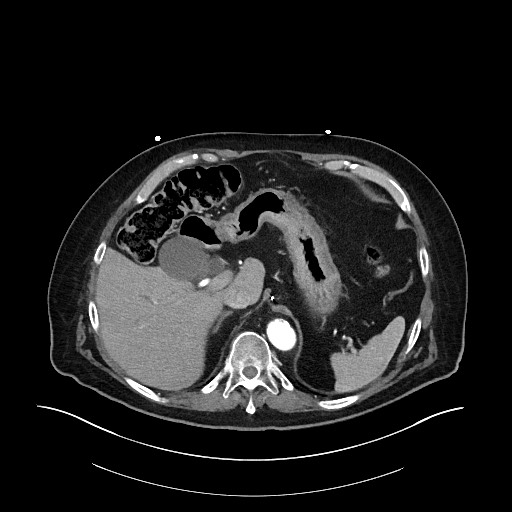 Ampullary adenocarcinoma (Radiopaedia 59373-66734 A 44).jpg