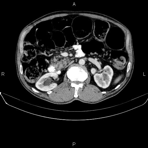 Ampullary adenocarcinoma (Radiopaedia 86093-102032 A 25).jpg