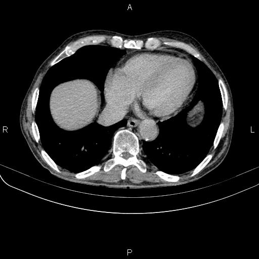 Ampullary adenocarcinoma (Radiopaedia 86093-102033 Axial C+ delayed 7).jpg