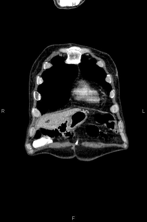 Ampullary adenocarcinoma (Radiopaedia 86093-102033 D 4).jpg