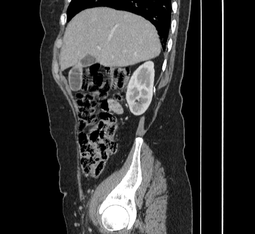File:Ampullary tumor (Radiopaedia 60333-67998 C 12).jpg