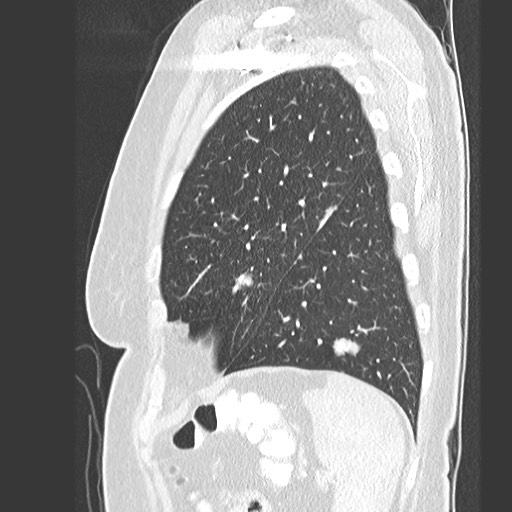 Amyloidosis - bronchial and diffuse nodular pulmonary involvement (Radiopaedia 60156-67745 Sagittal lung window 75).jpg