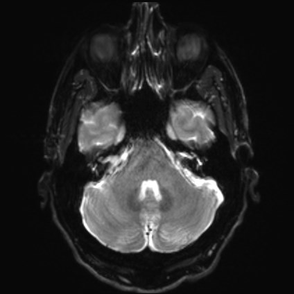 File:Amyotrophic lateral sclerosis (Radiopaedia 87352-103658 Axial DWI 6).jpg