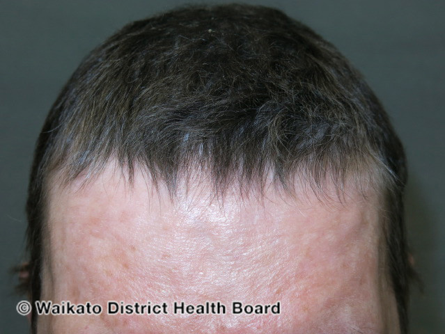 File:Anagen effluvium- regrowth after chemotherapy (DermNet NZ hair-nails-sweat-w-anagen-effluvium-05).jpg