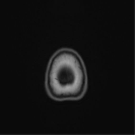 Anaplastic astroblastoma (Radiopaedia 55666-62194 Axial T1 74).png