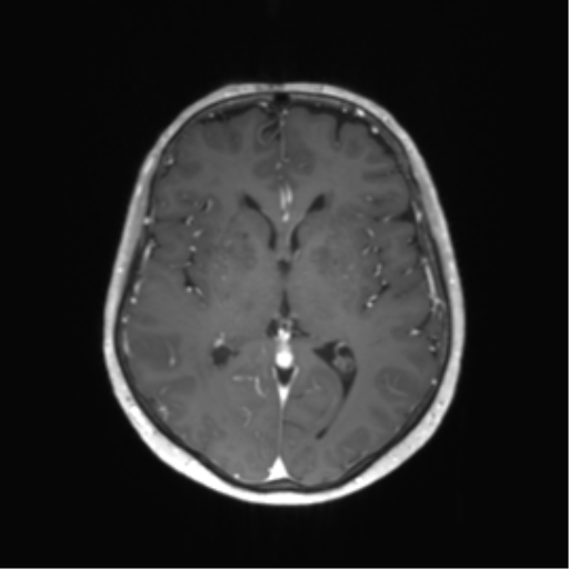 File:Anaplastic astrocytoma (Radiopaedia 86943-103160 Axial T1 C+ 28).png