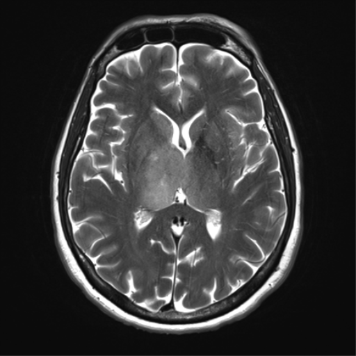 File:Anaplastic astrocytoma - thalamic glioma (Radiopaedia 59709-67115 Axial T2 20).png