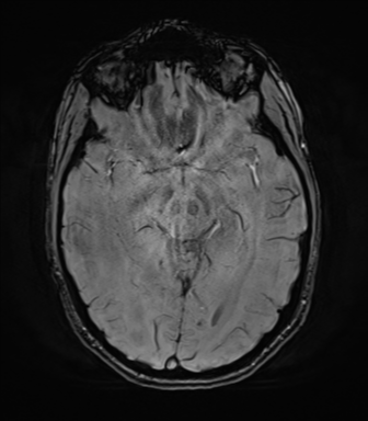 File:Anaplastic astrocytoma IDH mutant (Radiopaedia 50046-55341 Axial SWI 39).png