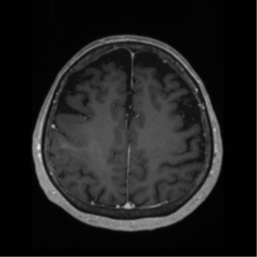 File:Anaplastic astrocytoma IDH wild-type (pseudoprogression) (Radiopaedia 42209-45276 Axial T1 C+ 106).png