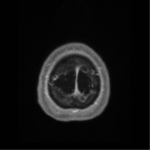 Anaplastic astrocytoma IDH wild-type (pseudoprogression) (Radiopaedia 42209-45276 Axial T1 C+ 140).png