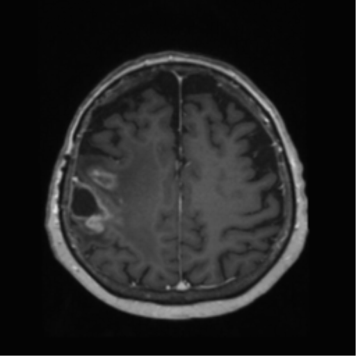 File:Anaplastic astrocytoma IDH wild-type (pseudoprogression) (Radiopaedia 42209-45278 Axial T1 C+ 112).png