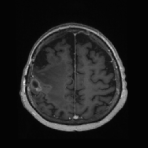 File:Anaplastic astrocytoma IDH wild-type (pseudoprogression) (Radiopaedia 42209-45278 Axial T1 C+ 116).png