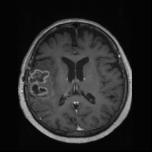 File:Anaplastic astrocytoma IDH wild-type (pseudoprogression) (Radiopaedia 42209-45278 Axial T1 C+ 91).png