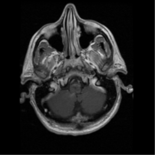 File:Anaplastic meningioma with recurrence (Radiopaedia 34452-35783 Axial T1 C+ 2).png