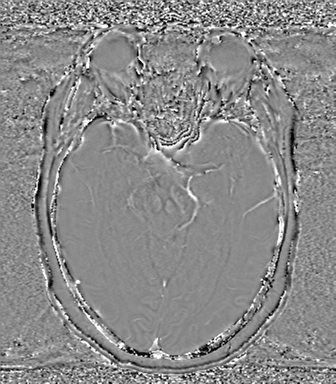 Anaplastic oligodendroglioma (Radiopaedia 83500-98599 Axial SWI - phase 34).png
