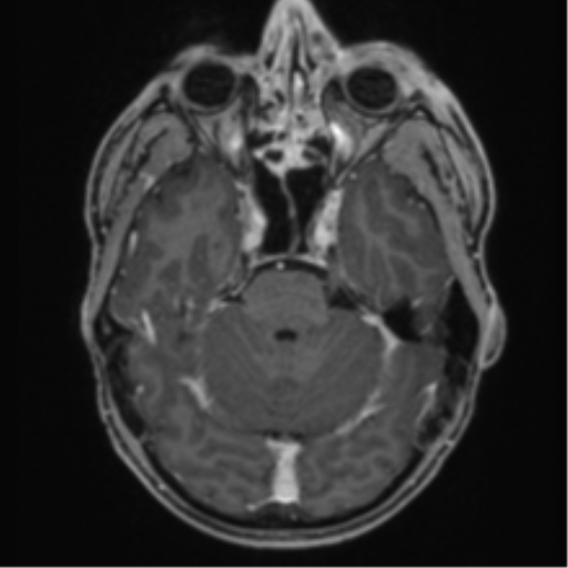 Anaplastic oligodendroglioma with skull fracture (Radiopaedia 74831-85845 Axial T1 C+ fat sat 17).png