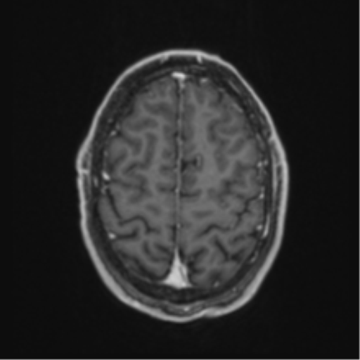 Anaplastic oligodendroglioma with skull fracture (Radiopaedia 74831-85845 Axial T1 C+ fat sat 54).png