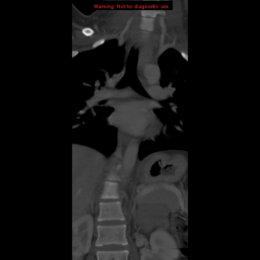 File:Aneurysmal bone cyst (Radiopaedia 9419-10102 Coronal bone window 2).jpg