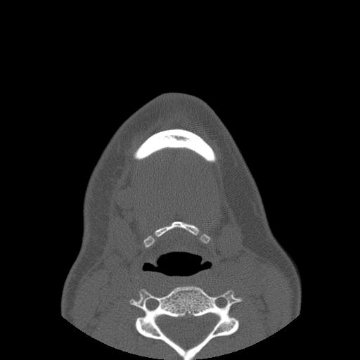 Aneurysmal bone cyst of the mandible (Radiopaedia 43280-46823 Axial bone window 8).jpg