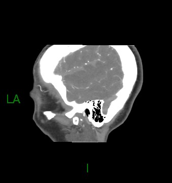 Aneurysmal subarachnoid hemorrhage with intra-axial extension (Radiopaedia 84371-99732 B 61).jpg
