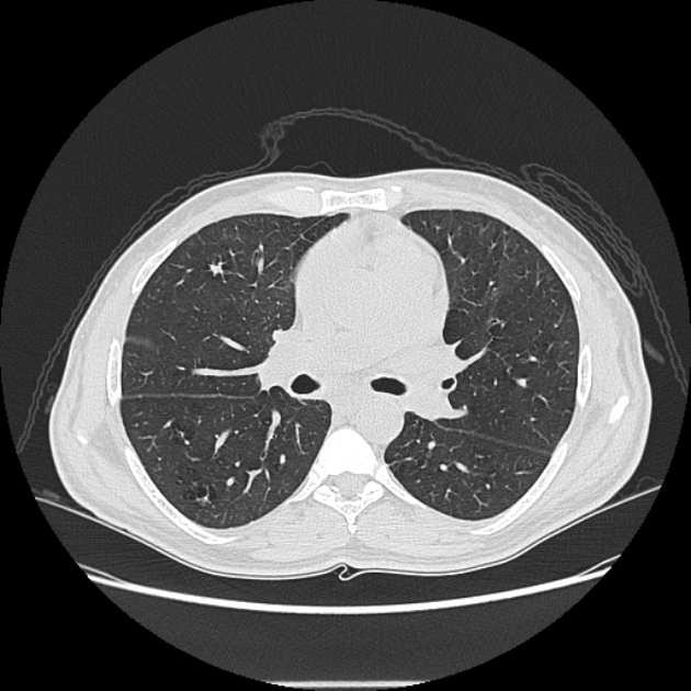 Angioinvasive aspergellosis (Radiopaedia 66995-76315 Axial lung window 23).jpg