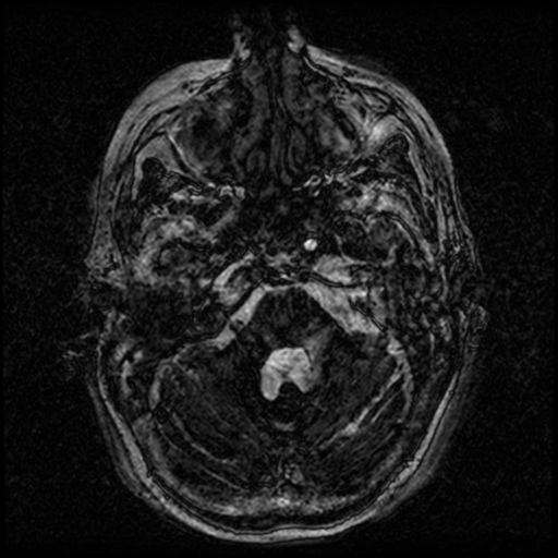 Angioinvasive aspergillosis in the pituitary fossa (Radiopaedia 39676-42010 Ax 3D FIESTA VOLUME 14).png