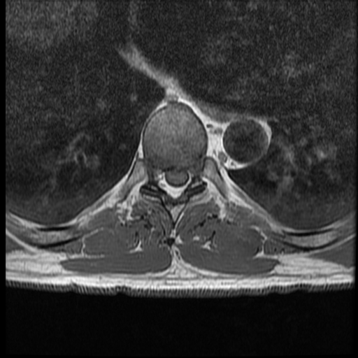 File:Angiolipoma - thoracic spine (Radiopaedia 28242-28479 Axial T1 4).jpg