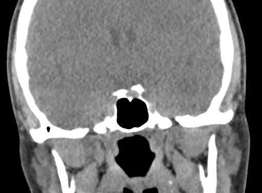 Angular dermoid cyst (Radiopaedia 88967-105790 Coronal non-contrast 60).jpg