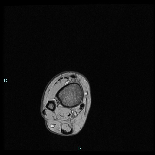 Ankle ganglion cyst (Radiopaedia 62809-71162 Axial Gradient Echo 92).jpg